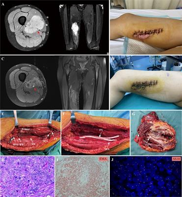 Clinical outcomes after vascular reconstruction using synthetic grafts for limb salvage in patients with lower extremity sarcoma: a single-center retrospective experience